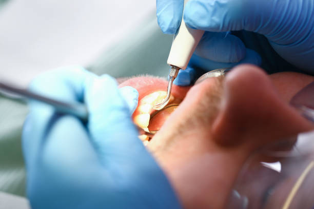 Best Emergency Tooth Extraction in Montpelier, OH
